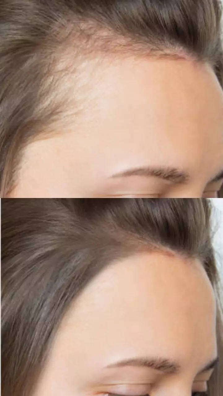 easy-home-remedies-to-reverse-balding